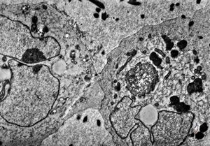 F,16y. | bone marrow -malignant histiocytosis